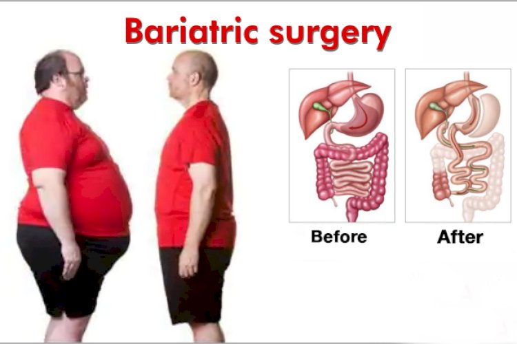 बेरिएट्रिक सर्जरी से वजन कम होने के साथ जिंदगी में भी होगा सुधार।