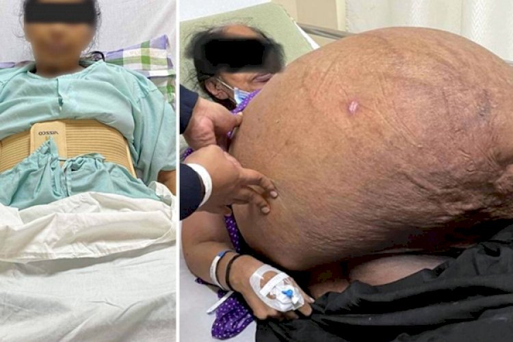 अपोलो अस्पताल के डॉक्टरों ने एक महिला के पेट से निकाला 47 किलोग्राम का ट्यूमर, बचाई जान