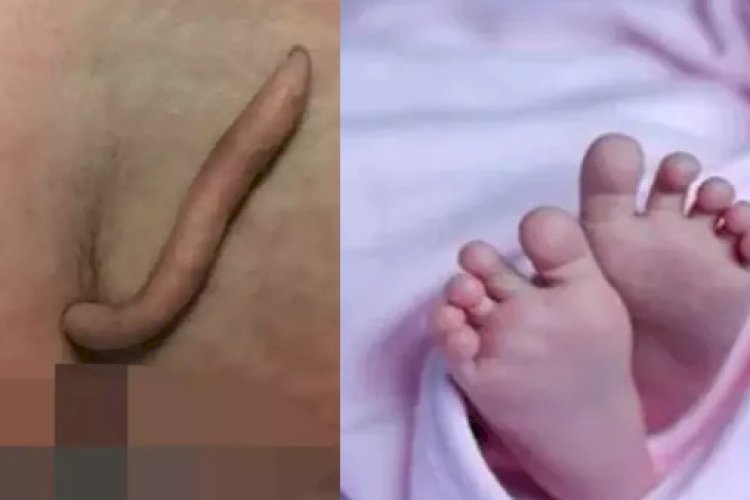 6 सेंटीमीटर ‘लंबी पूंछ’ के साथ पैदा हुई बच्ची