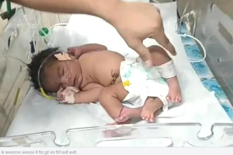 एमपी में महिला ने दिया चार पैरों वाली बच्ची को जन्म